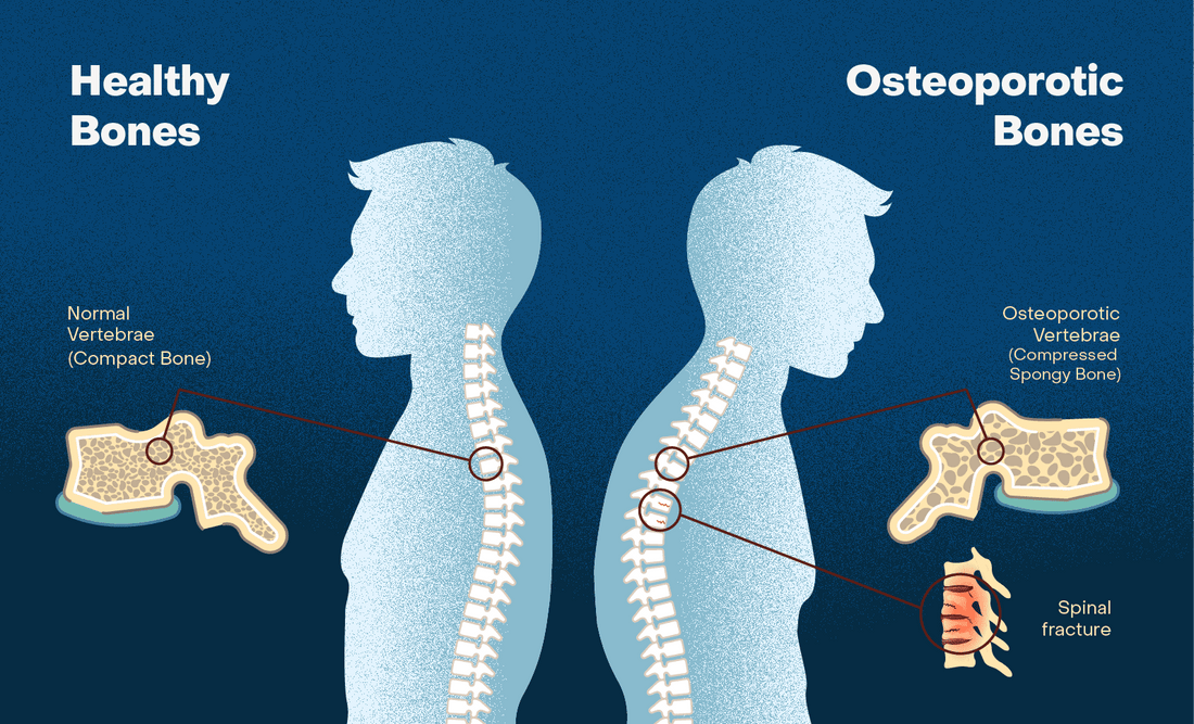 Are You Concerned with Bone Mass Density or Have You Been Diagnosed with Osteoporosis?