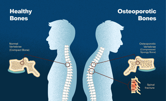 Are You Concerned with Bone Mass Density or Have You Been Diagnosed with Osteoporosis?